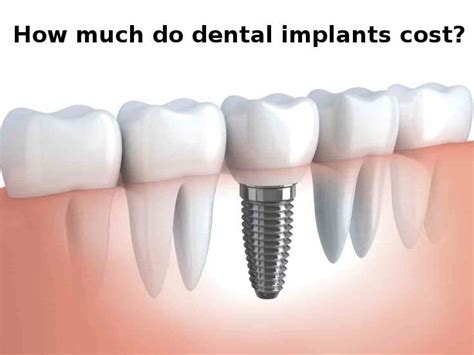 Dental Implants Cost in Cambodia: A Comprehensive Guide.